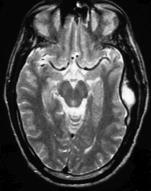 Intracranial epidural abscess on the MRI of a patient (source)