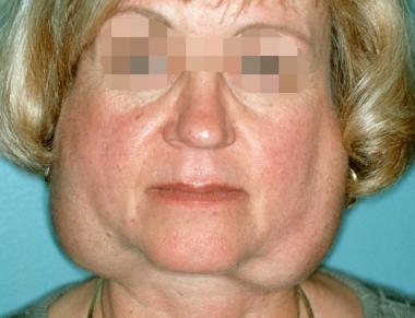 This patient with Sjögren syndrome has very obvious bilateral parotid gland swelling (source)