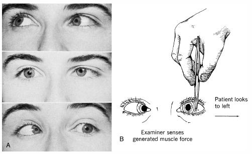 The patient above has a left lateral rectus palsy. Patients with Wernicke encephalopathy may have unilateral or bilateral palsies like this one (source)