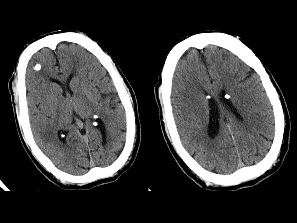 Head CT of a patient which tuberous sclerosis shows multiple periventricular calcifications (source) 