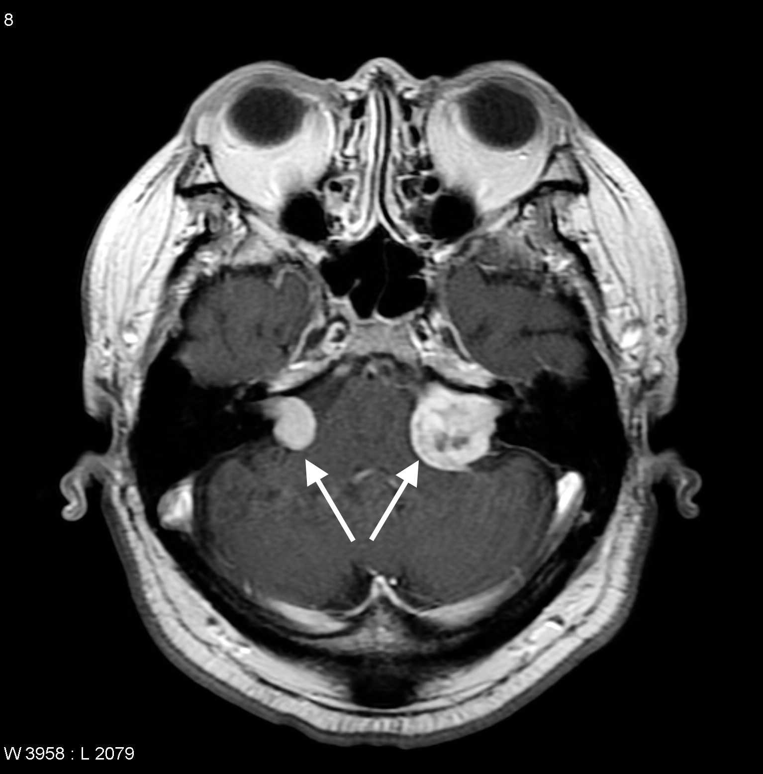 Bilateral acoustic neuromas seen on an MRI in a patient with NF2 (source)