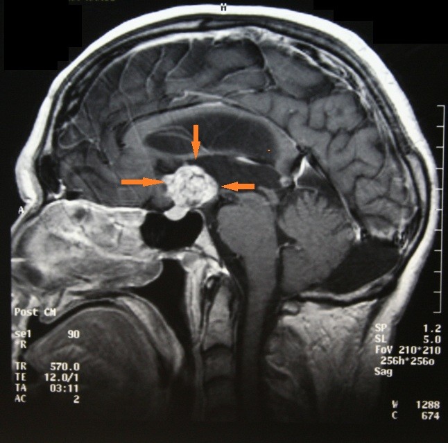 MRI showing a calcified craniopharyngioma tumor (source) 