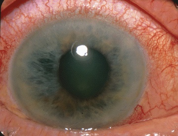 Visual appearance of acute angle-closure glaucoma (source) 
