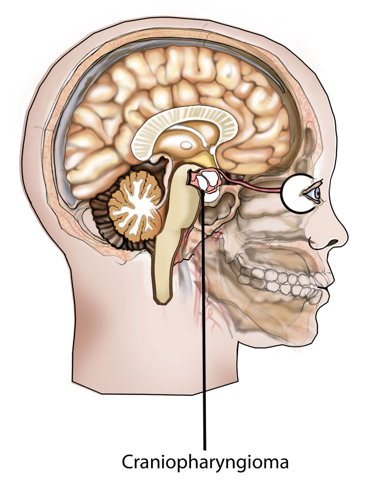 Anatomical location of a craniopharyngioma (source)