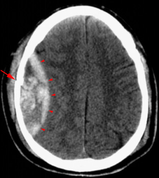 Appearance of epidural hematoma on a CT scan. The arrow heads outline the lens shaped bleeding, and the arrow points out the skull fracture (source) 