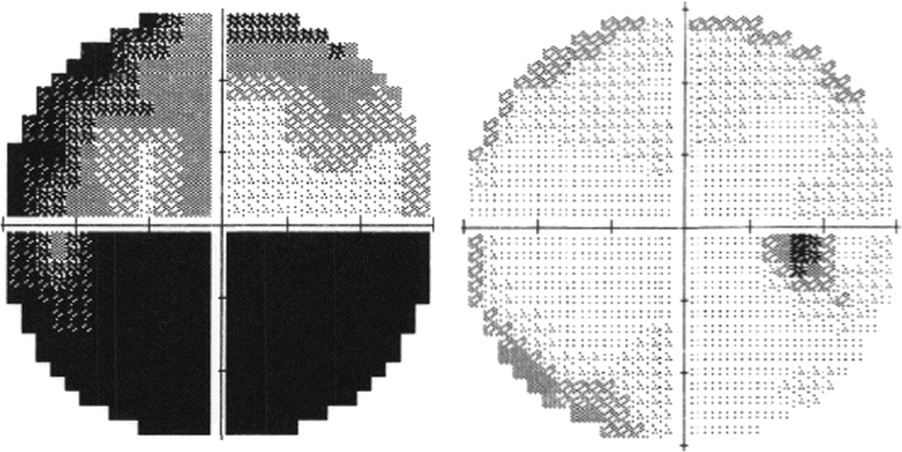 Formal and computerized visual field testing can be done in patients with suspected glaucoma (source)