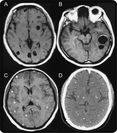 (A) MRI of vesicular cysticerci. (B) MRI of colloidal cysticerci. (C) MRI of nodular cysticerci. (D) CT scan of calcified cysticerci (source)