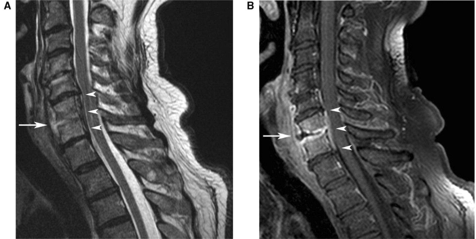 MRI images of a spinal epidural abscess that is causing spinal cord compression (source)