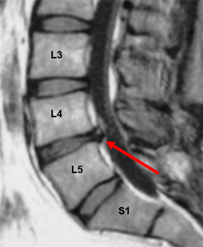 A herniated disk can be visualized with an MRI (source)