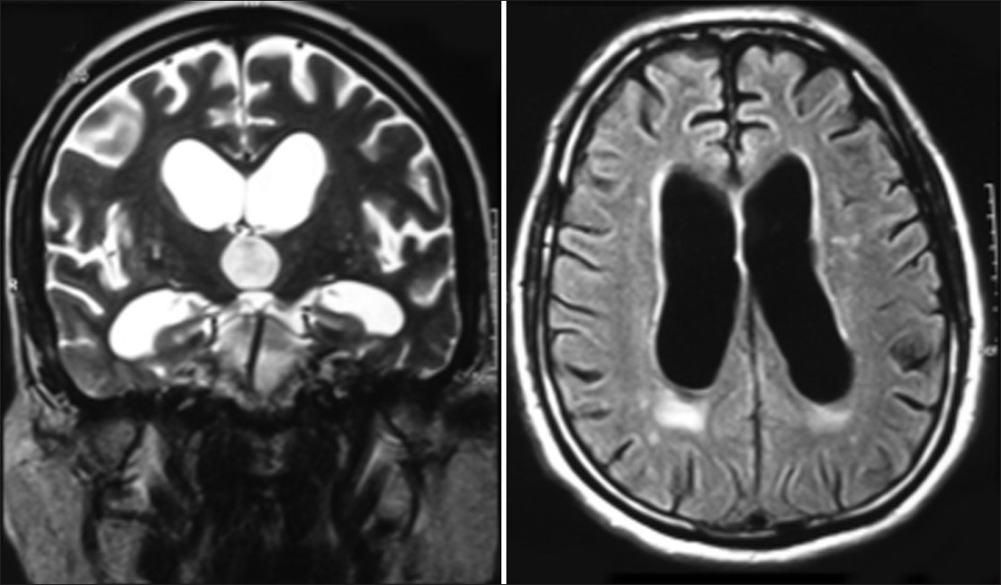 This MRI study shows a patient with NPH who has very enlarged ventricles (source)