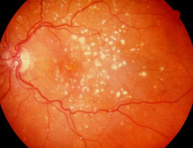 Visual appearance of dry macular degeneration. 