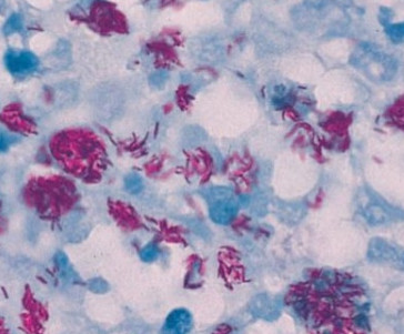 Visual appearance of Mycobacterium tuberculosis with an acid fast stain (pink rods, source)