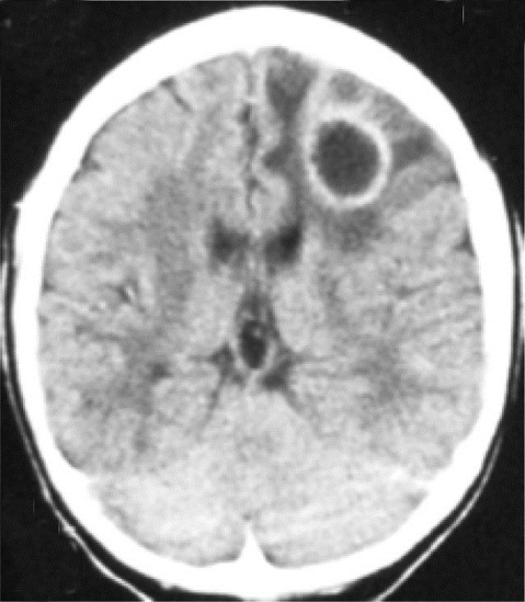 Large ring enhancing lesion seen on a CT scan of a patient with toxoplasmosis (source).