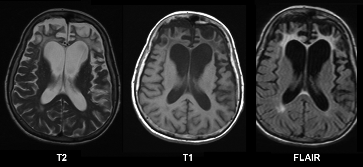 MRI sequences showing degeneration of cortical tissues in a patient with Pick disease (source) 