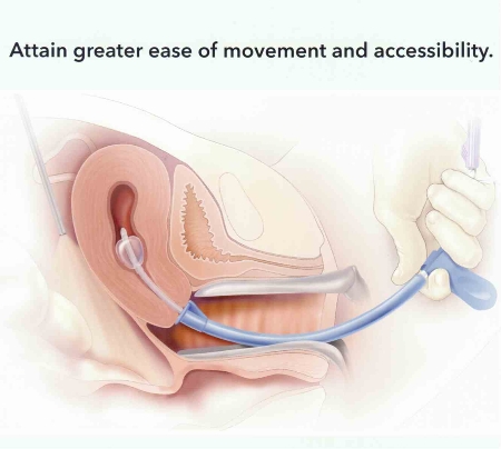 There are many different types of uterine manipulators. Regardless of the type, they are used to assist with positioning during the surgery (source)