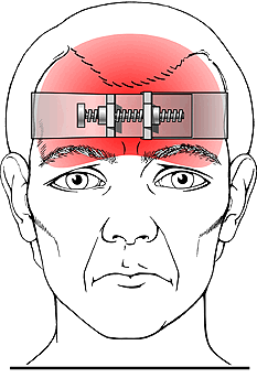 A tension-type headache gets its name from the unique quality of pain felt by patients. Often it is described as a "band-like pain" around the head (source)