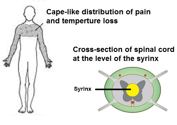 Given the location of the cavity, it will often first impair the crossing of the pain/temperature fibers int the spinal cord. This will lead to the bilateral loss of sensation in the so called "cape-like fashion" (source)