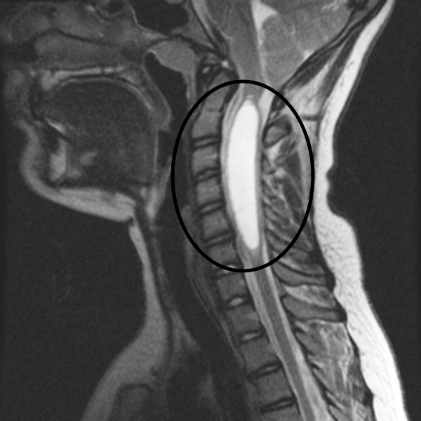 Syringomyelia Stepwards