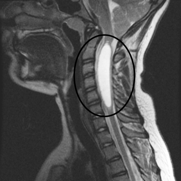 This T2 sagittal MRI of the cervical spine clearly shows the syringomyelia (source)