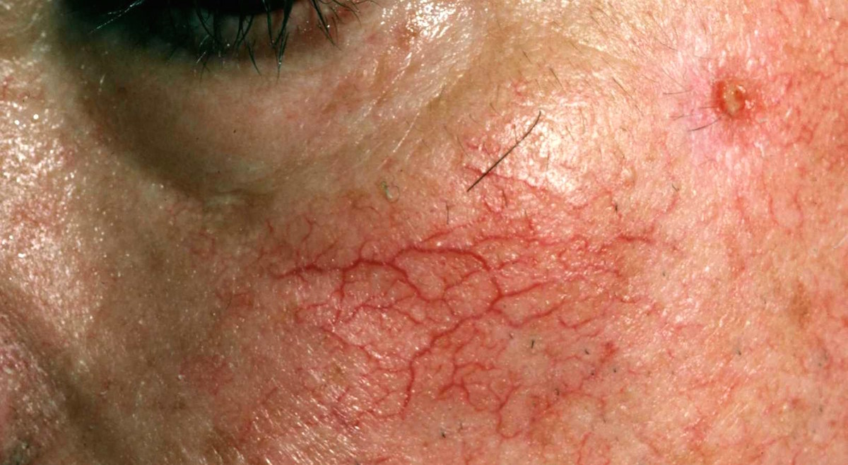 Telangiectasias Stepwards