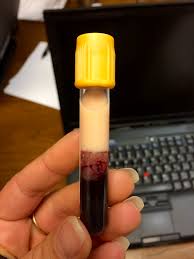 Blood samples with high levels of lipids/proteins may be prone to lab errors that report isotonic hyponatremia (source) 