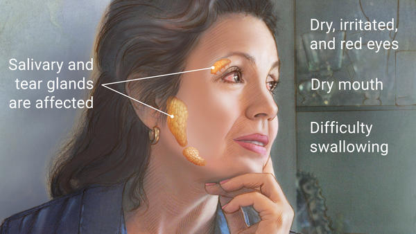 Sjögren syndomre is typically characterized by the auto-immune destruction of the salivary and lacrimal glands (source)