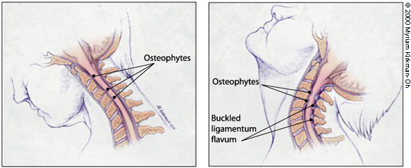 This condition is caused by the degeneration of the cervical vertebral bodies/disks (source) 