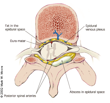 Depiction of an epidural abscess in the spine (source)
