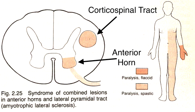 ALS will lead to lesions in both the corticospinal tract and the anterior horn. This is what causes the constellation of upper and lower motor neuron symptoms (source)