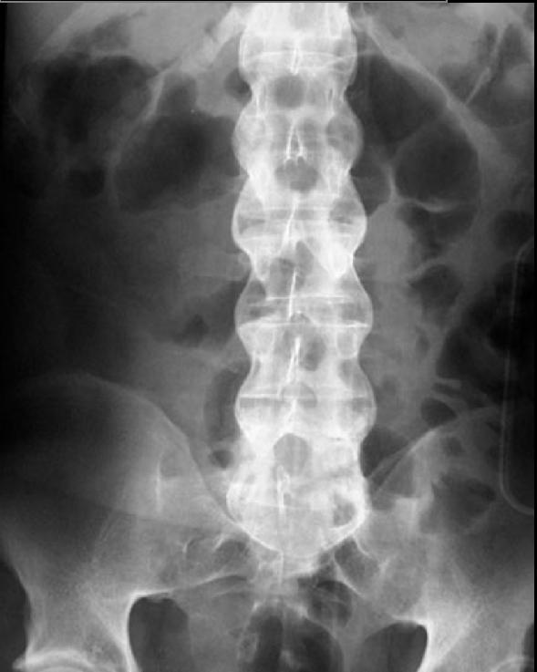 The above X-ray shows the characteristic appearance of the "bamboo spine" that is observed in ankylosing spondylitis (source) 