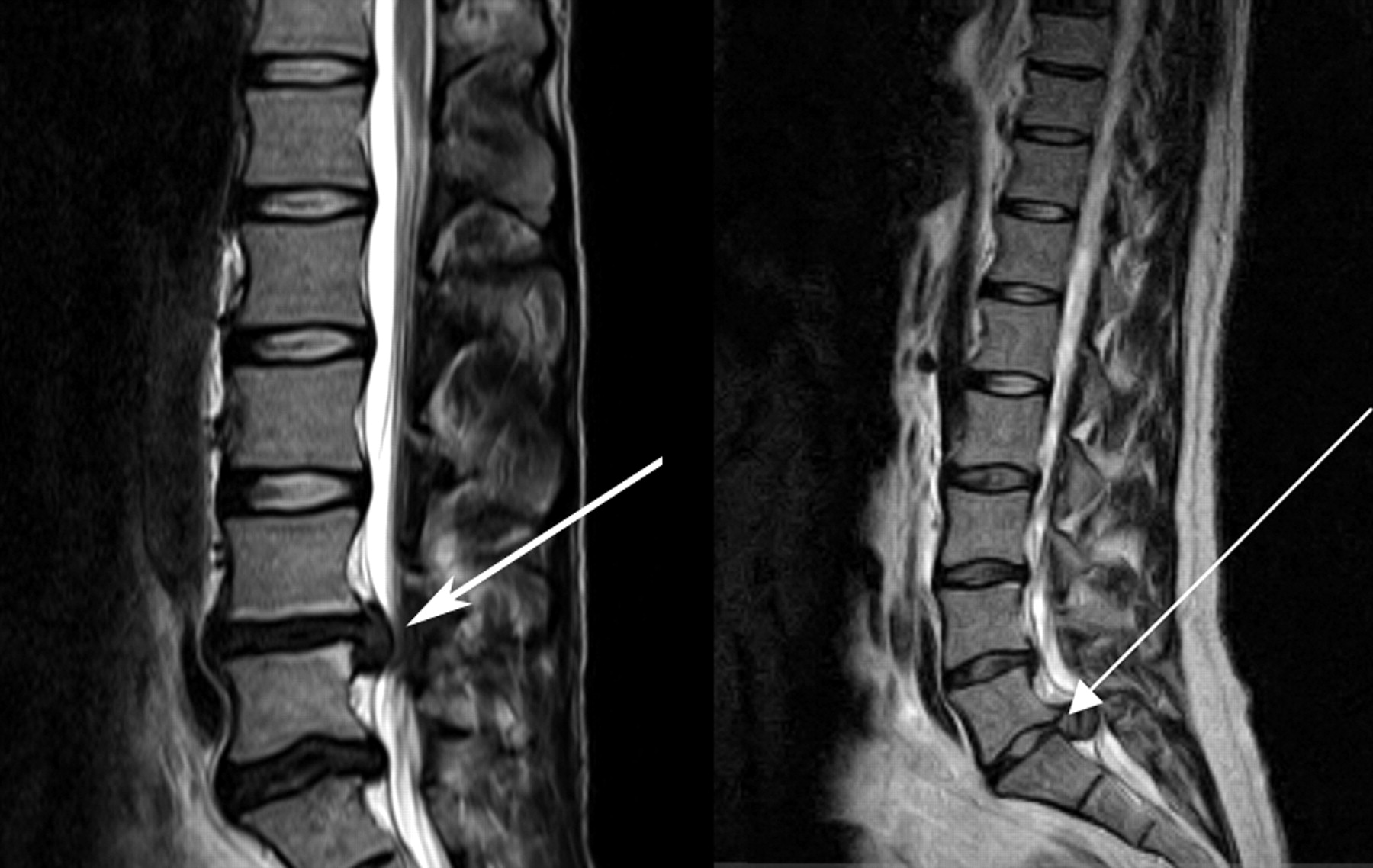 Large disk herniations (pictured in the MRIs above) can be the cause of cauda equina syndrome (source)