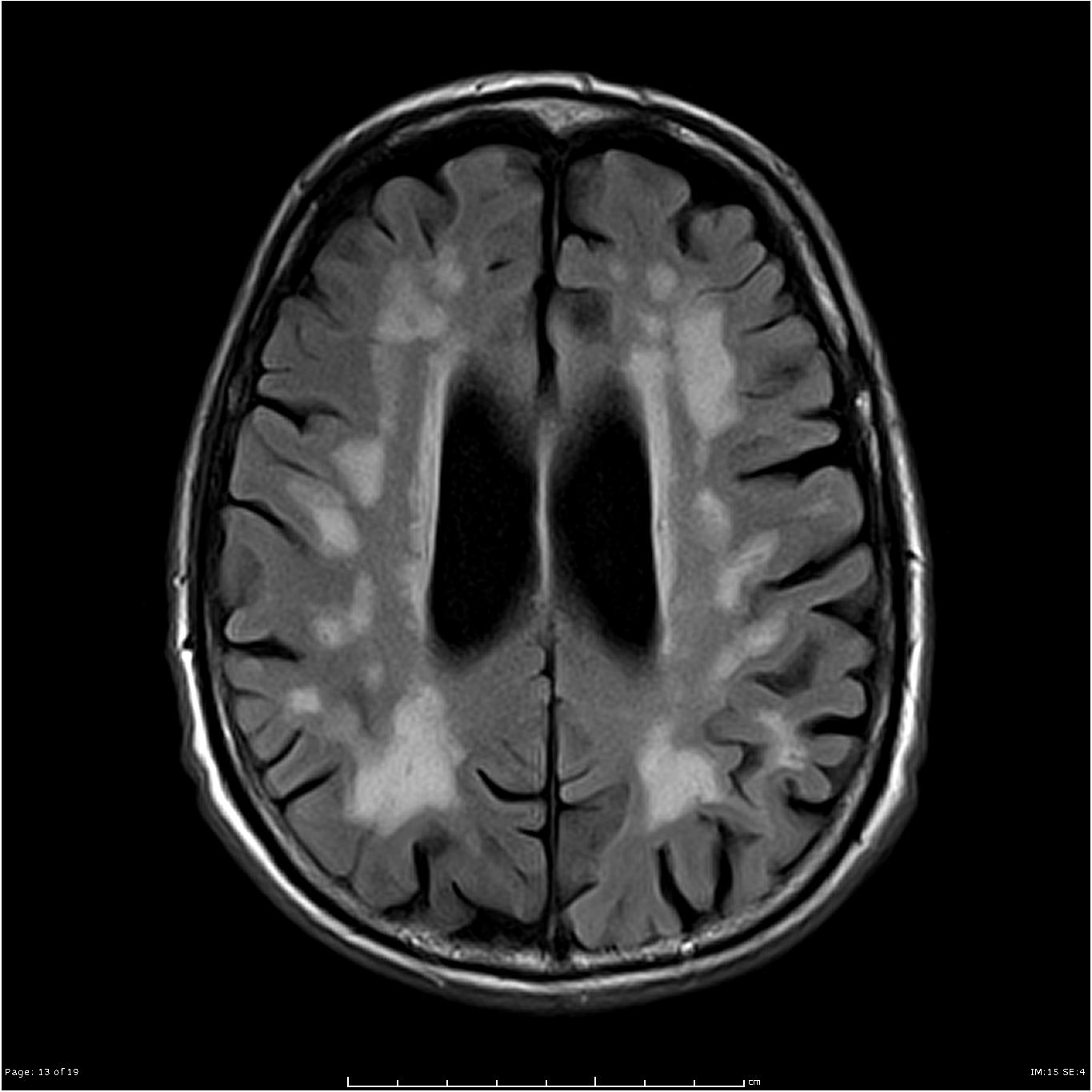MRI can show evidence of past vascular damage in the brain. This (in the absence of other pathology) is consistent with a diagnosis of vascular dementia (source)