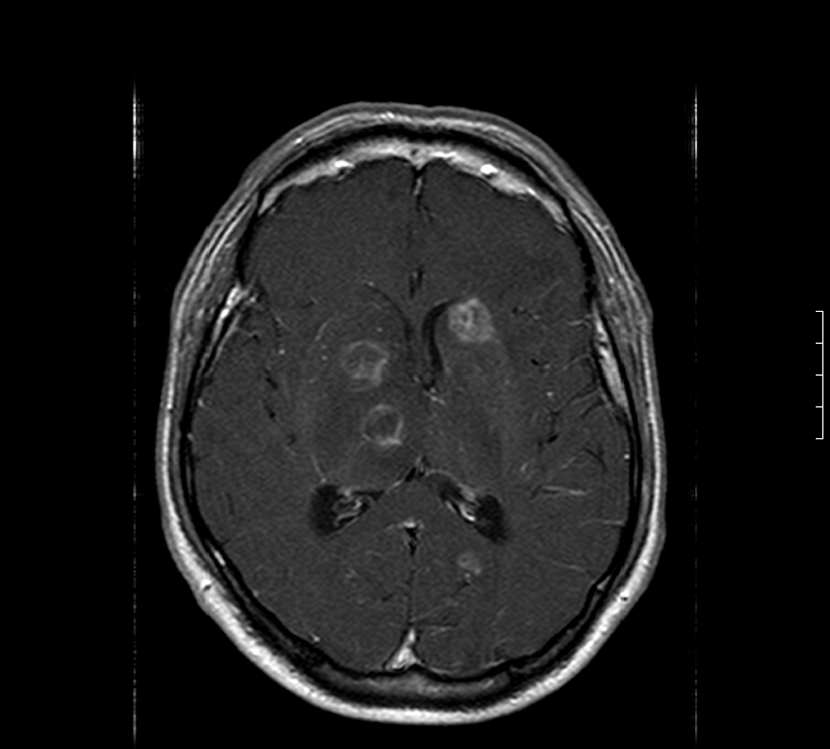 Multiple lesions seen in the MRI of a patient with toxoplasmosis (source)