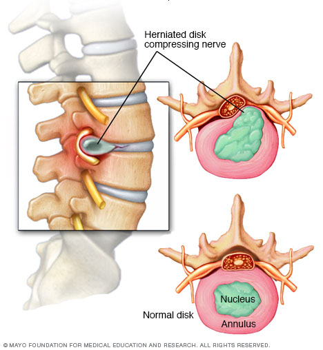 Anatomical representation of intervertebral disk herniation (source) 