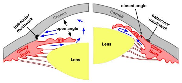 Comparison between open and closed-angle glaucoma. The real difference is due to WHERE the pressure/fluid collects in the eye (relative to the iris, source)