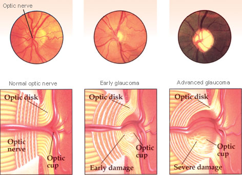 Cupping of the optic nerve (source)