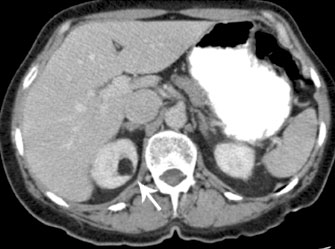 Angiomyolipoma on a CT scan (source) 