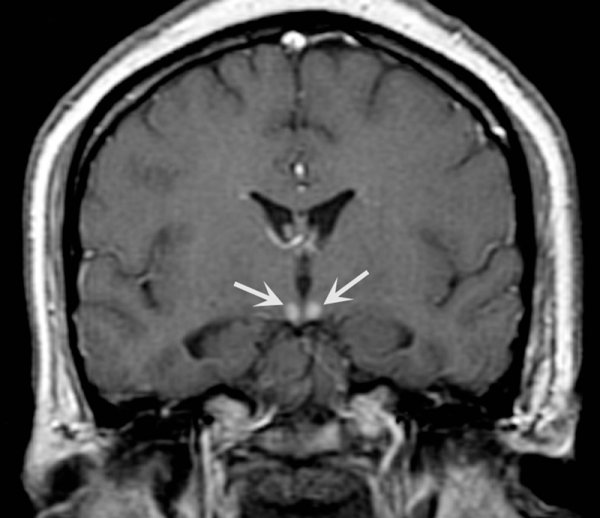 Maxillary body single enhancement (signifying necrosis/neuronal cell death) on MRI imaging can be seen in patients with Wernicke encephalopathy (source)