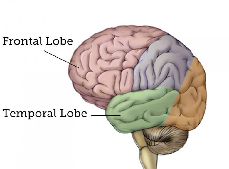 The frontal and temporal lobes of the brain are affected in Pick disease (source)