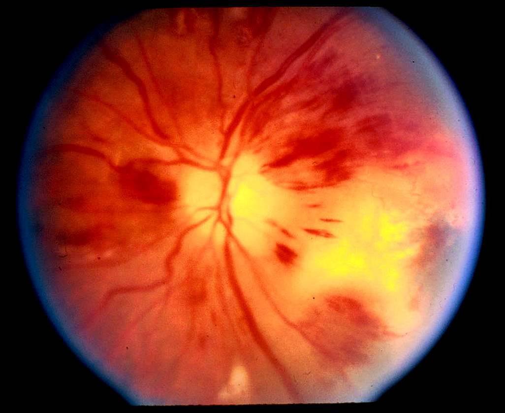 Papilledema and flame hemorrhages seen in a patient with hypertension (source) 