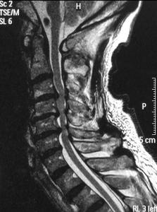 MRI showing severe spondylotic cervical myelopathy (source)