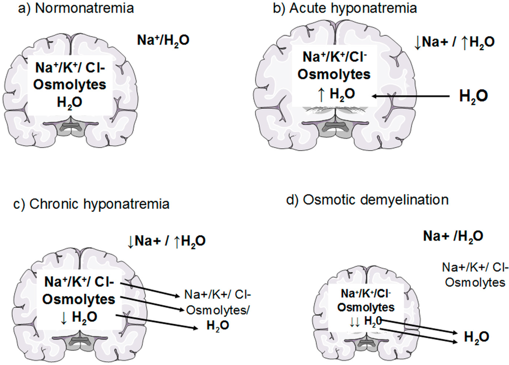 It is important to appreciate the delicate balance between electrolytes and fluid that exist in the brain. Hyponatremia will cause influx of water into the brain. Similarly, rapid correction of hyponatremia will result in rapid water loss, as osmotic demyelination (source) 