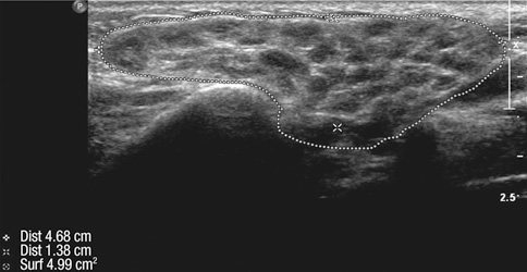 Confirmation of parotid gland swelling (via ultrasound) in a patient with Sjögren syndrome (source) 