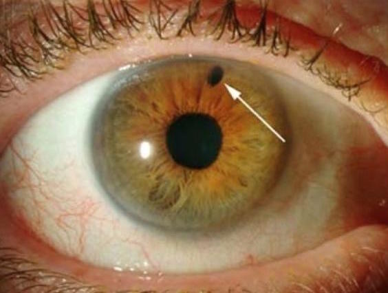 Laser iridotomy can be done to make a hole in the iris. This will allow for the flow of trapped fluid out form behind the iris, and into the trabecular drainage system (source) 