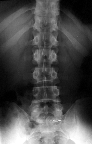 A herniated disk is not often easily visualized with an X-ray, however other causes of the back pain may be ruled out (source)