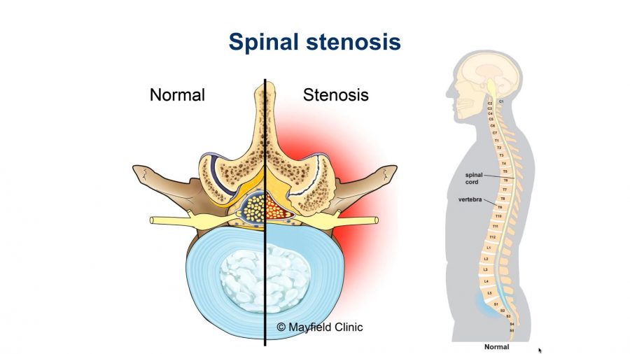 Lumbar Spinal Stenosis Stepwards