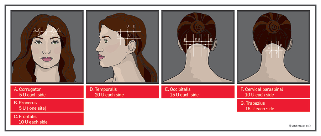 Botox injections can sometimes be used for headache relief. The above schematic shows the injection sites that can be used (source) 
