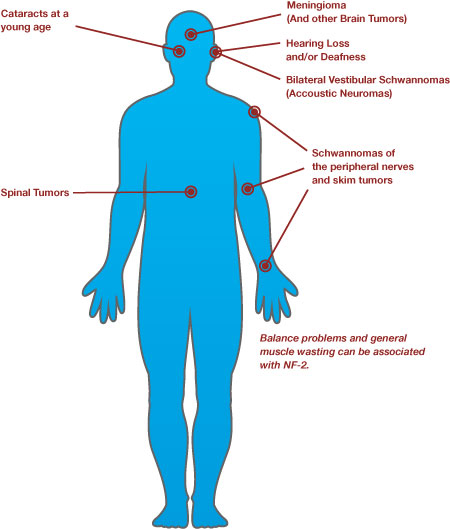 Various findings in NF2 (source) 