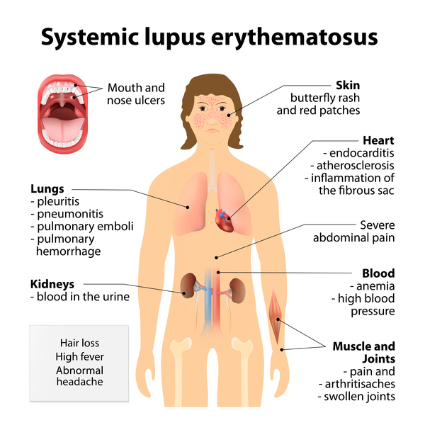 Signs and symptoms found in SLE (source)