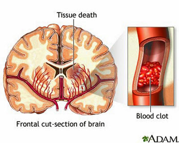 Cerebrovascular disease is ultimately the cause of vascular dementia (source)